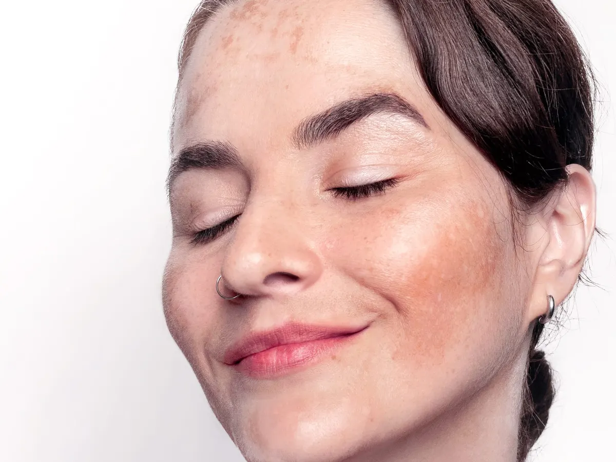 Stock photograph of a model: a smiling woman with her eyes closed, freckles and darker patches across her cheeks and forehead