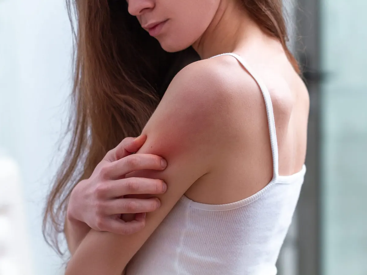 Stock photograph of a model: a young woman scratches a red, irritated patch on her upper arm