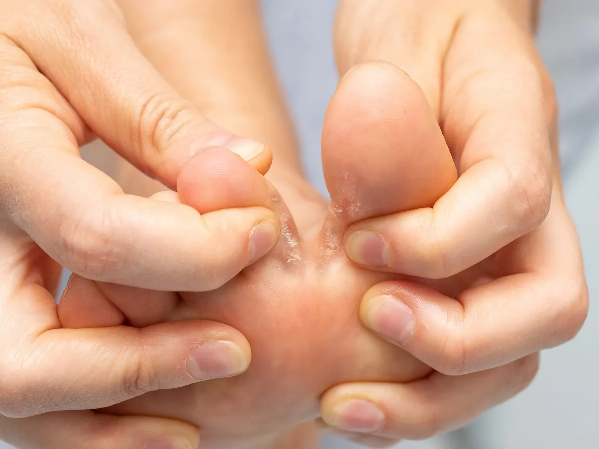 Stock photograph of a model: hands part the toes of a bare foot to show peeling skin between them