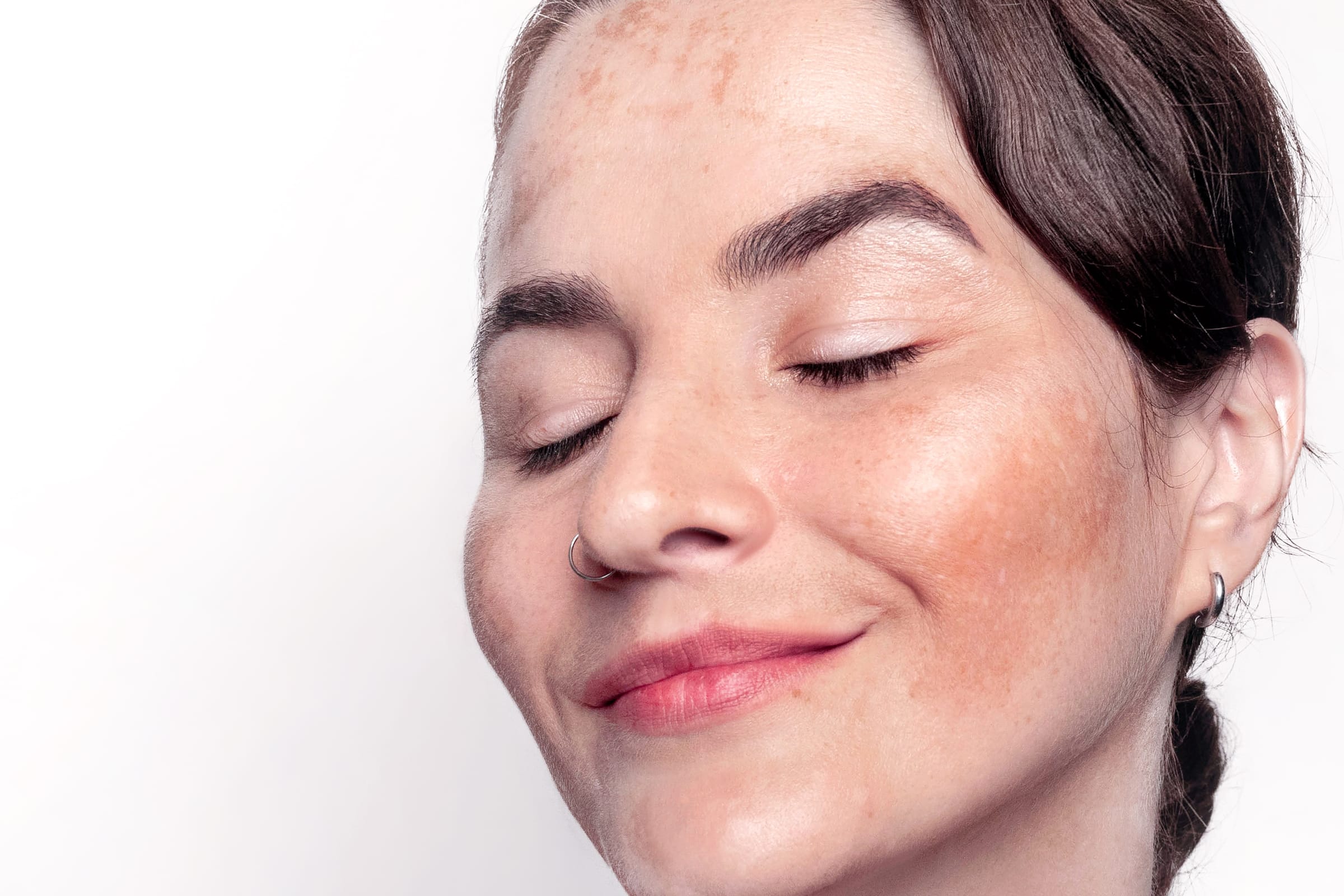 Stock photograph of a model: a smiling woman with her eyes closed, freckles and darker patches across her cheeks and forehead