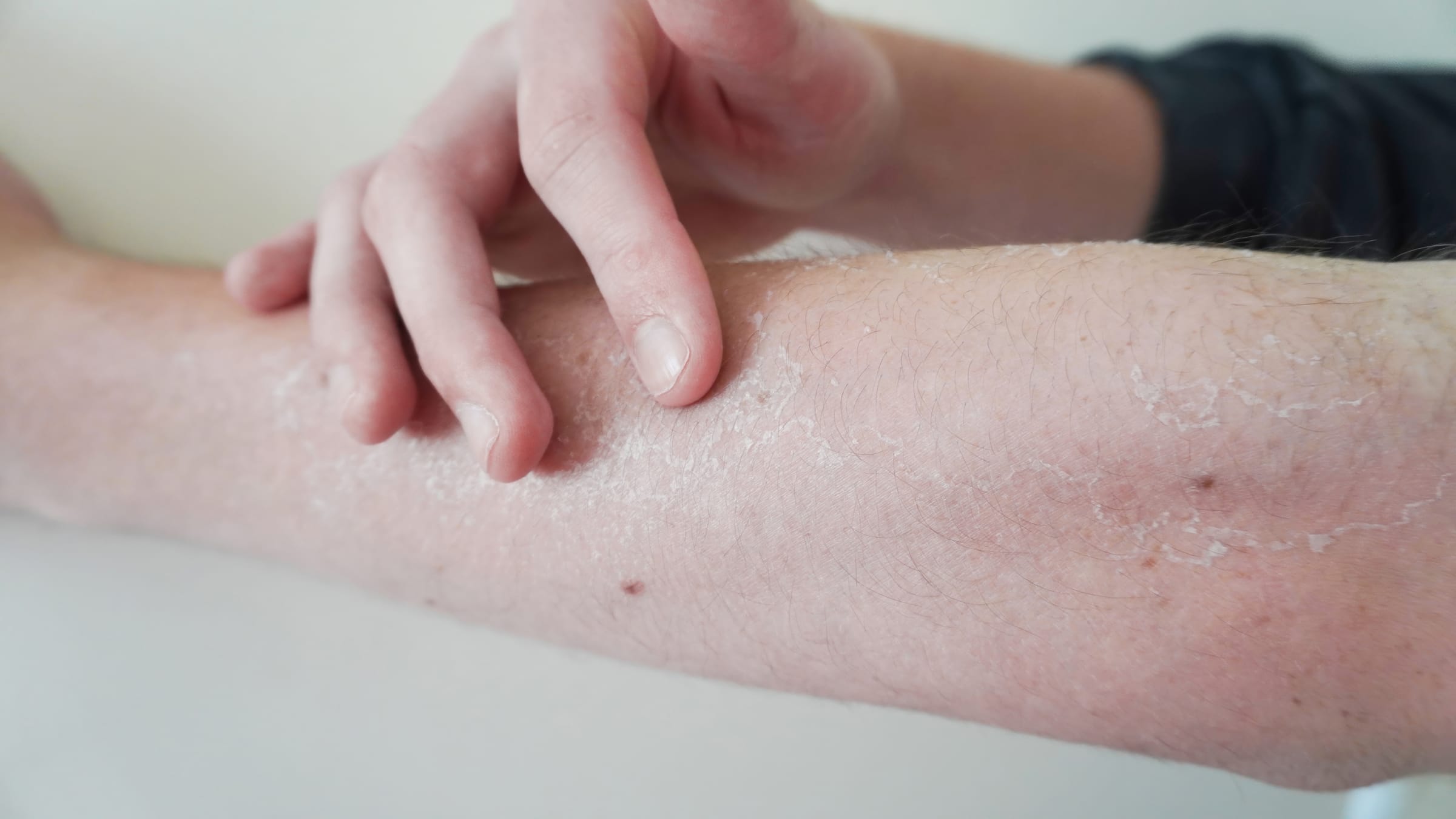 Stock photograph of a model: a hand scratches a forearm with dry, flaky, red skin