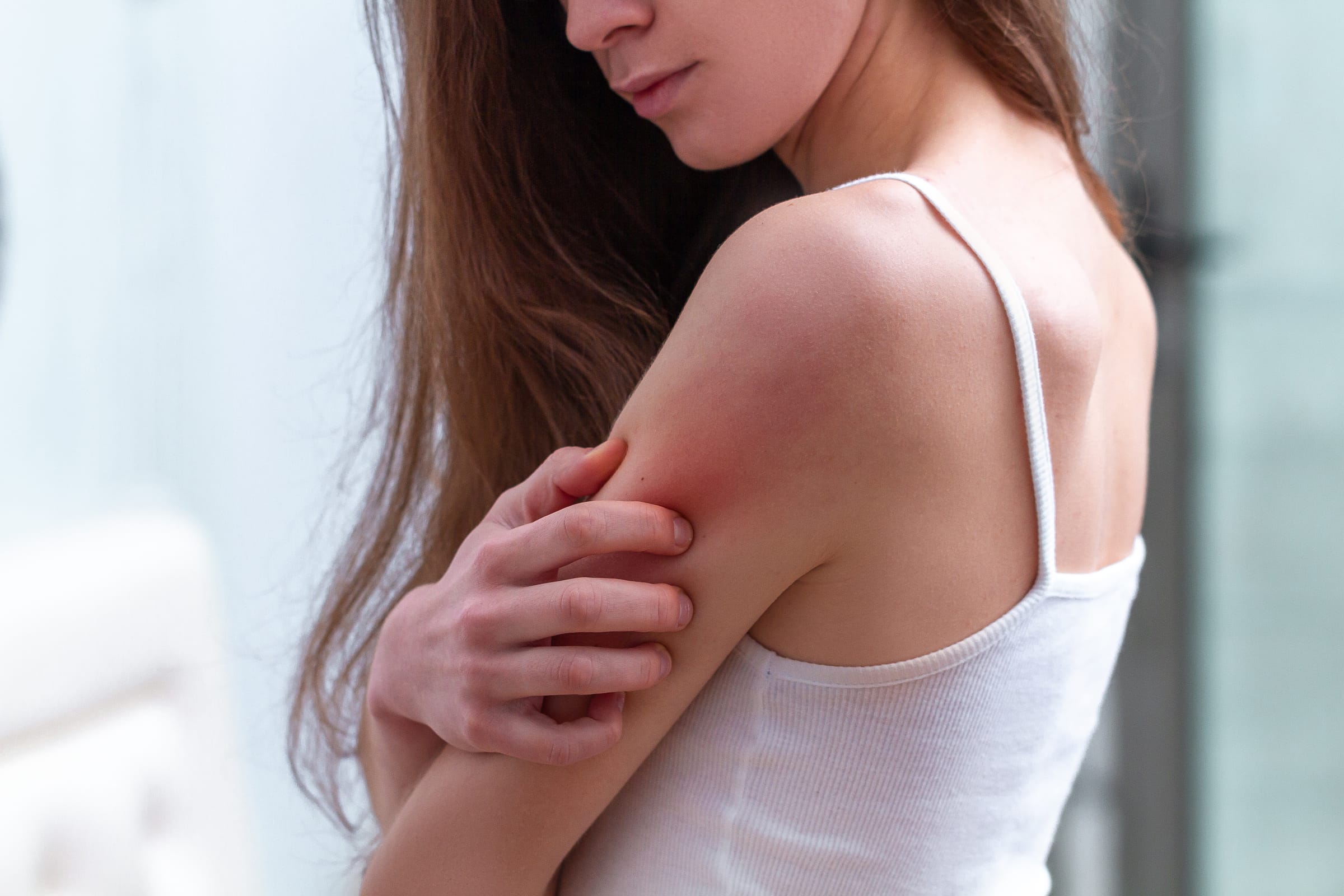 Stock photograph of a model: a young woman scratches a red, irritated patch on her upper arm