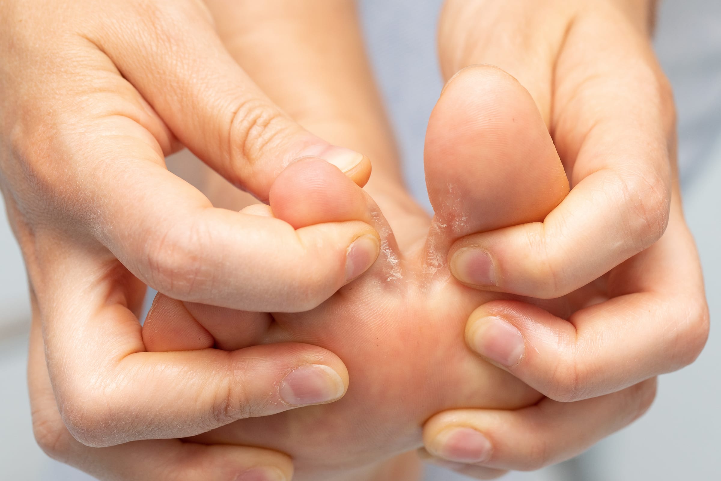 Stock photograph of a model: hands part the toes of a bare foot to show peeling skin between them